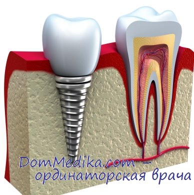 имплантация зубов